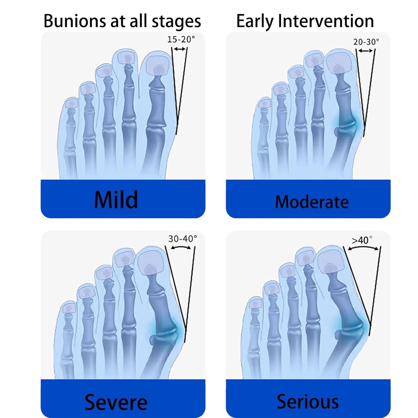 Premium Bunion Corrector Brace ™Letshome Wellness
